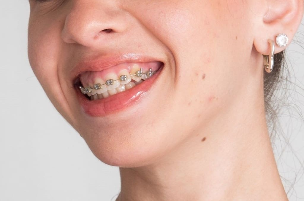 Close-up of a smile with traditional metal braces